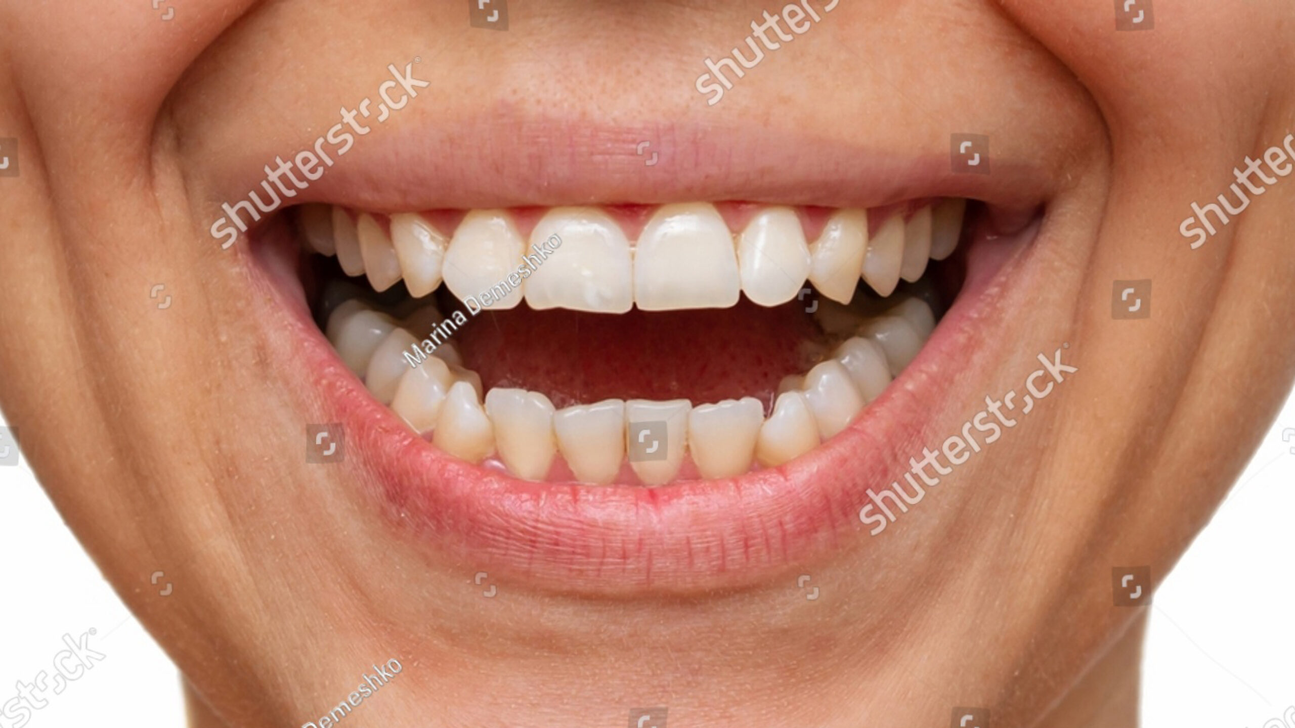 Smile_BeforeAfter_Examples_003