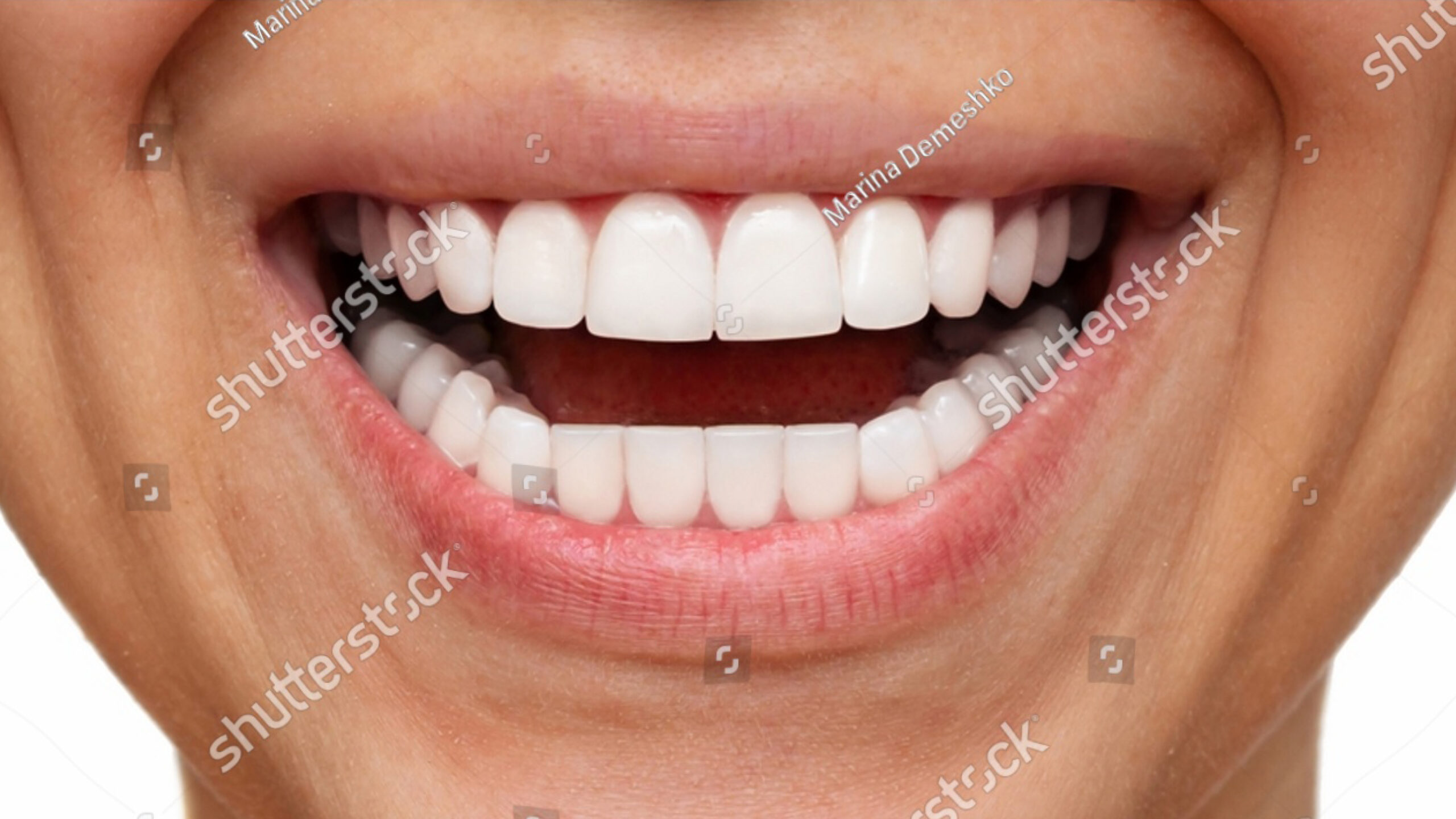 Smile_BeforeAfter_Examples_004